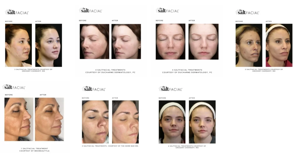 Salt Facial before and after photos