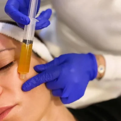 A close-up of a person receiving a PRP (Platelet-Rich Plasma) injection or filler in their cheek. A medical professional, wearing bright blue gloves, is holding a syringe filled with a golden-yellow liquid (plasma) and injecting it near the corner of the patient's eye or temple area. The patient is lying down with their eyes closed and is wearing a white headband.